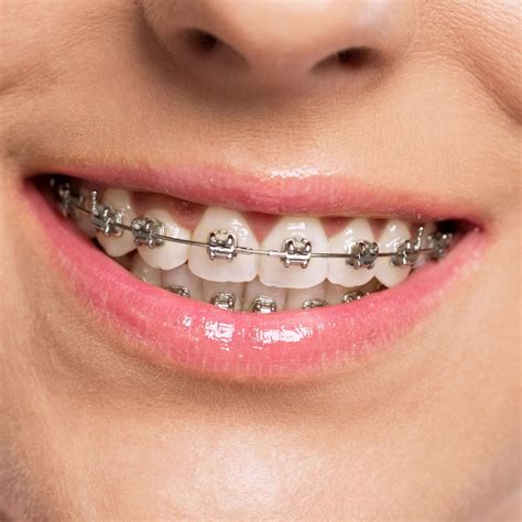 types of metal braces brackets|removable metal braces.